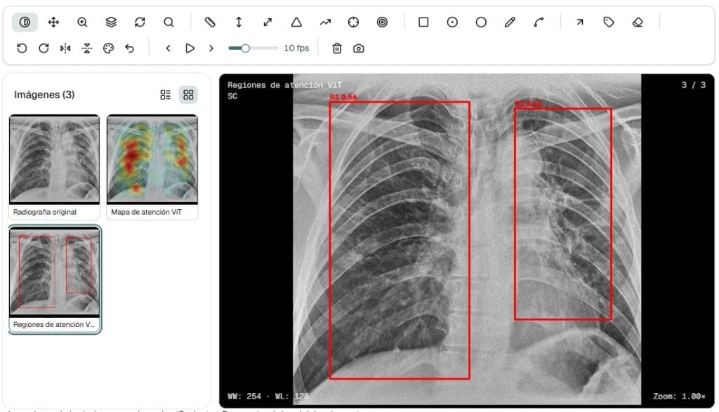 Visor radiológico con radiografía de tórax, mapa de atención ViT y regiones de atención marcadas